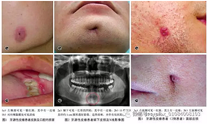 【臨床研究】牙源性皮瘺9例臨床分析