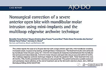 文獻優(yōu)秀正畸病例賞析-通過微種植釘及多曲方絲技術(shù)壓低下頜磨牙非手術(shù)矯治嚴重前牙開合患者1例