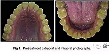 文獻優(yōu)秀正畸病例賞析-通過微種植釘及多曲方絲技術(shù)壓低下頜磨牙非手術(shù)矯治嚴重前牙開合患者1例