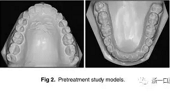 文獻優(yōu)秀正畸病例賞析-通過微種植釘及多曲方絲技術(shù)壓低下頜磨牙非手術(shù)矯治嚴重前牙開合患者1例