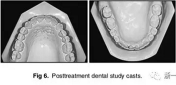 文獻優(yōu)秀正畸病例賞析-通過微種植釘及多曲方絲技術(shù)壓低下頜磨牙非手術(shù)矯治嚴重前牙開合患者1例