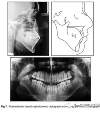 文獻優(yōu)秀正畸病例賞析-通過微種植釘及多曲方絲技術(shù)壓低下頜磨牙非手術(shù)矯治嚴重前牙開合患者1例