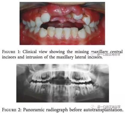 文獻(xiàn)優(yōu)秀正畸病例賞析--上頜中切牙區(qū)受傷后自體牙移植及正畸治療13年隨訪病例