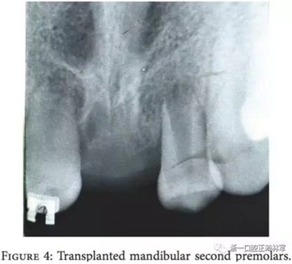 文獻(xiàn)優(yōu)秀正畸病例賞析--上頜中切牙區(qū)受傷后自體牙移植及正畸治療13年隨訪病例