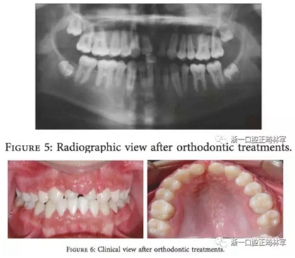 文獻(xiàn)優(yōu)秀正畸病例賞析--上頜中切牙區(qū)受傷后自體牙移植及正畸治療13年隨訪病例