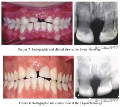 文獻(xiàn)優(yōu)秀正畸病例賞析--上頜中切牙區(qū)受傷后自體牙移植及正畸治療13年隨訪病例
