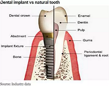種植體，在全球牙科設(shè)備市場(chǎng)的變化！
