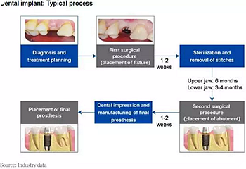 種植體，在全球牙科設(shè)備市場(chǎng)的變化！