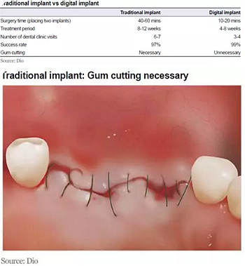 種植體，在全球牙科設(shè)備市場(chǎng)的變化！