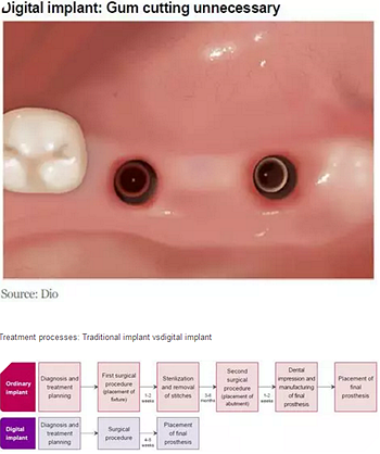種植體，在全球牙科設(shè)備市場(chǎng)的變化！