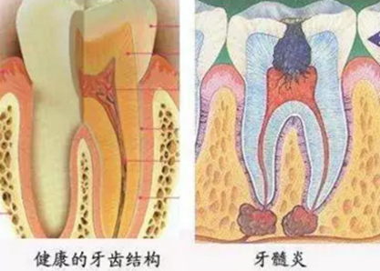 牙髓癥狀的鑒別