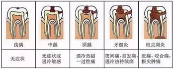 牙齒從針眼大的洞到拔除，步步驚心！