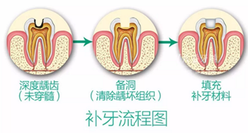 完全不懂，各種補(bǔ)牙材料，到底怎么選？