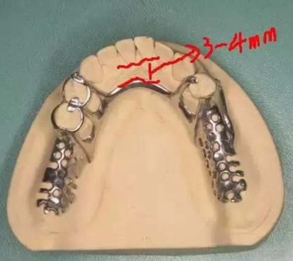 活動義齒修復(fù)，要懂的鋼托設(shè)計