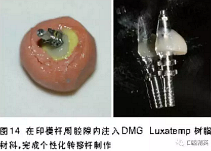 前牙即刻種植并個性化基臺美學修復