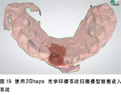 前牙即刻種植并個性化基臺美學修復