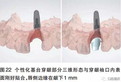 前牙即刻種植并個性化基臺美學修復