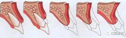激光輔助牙槽嵴保存技術(shù)