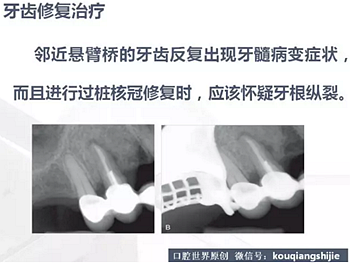 牙根縱裂