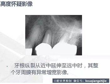 牙根縱裂