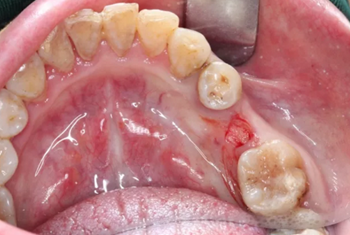 【病例分享】Implant Guide?數(shù)字化全程導(dǎo)航及椅旁即刻修復(fù)一例