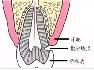 楔狀缺損是幾個(gè)意思 ?