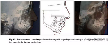 正畸文獻閱讀--單側(cè)唇腭裂患者的多學(xué)科綜合序列治療