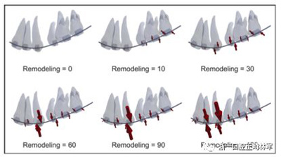 正畸文獻(xiàn)閱讀--對(duì)于滑動(dòng)法關(guān)閉間隙的有限元分析
