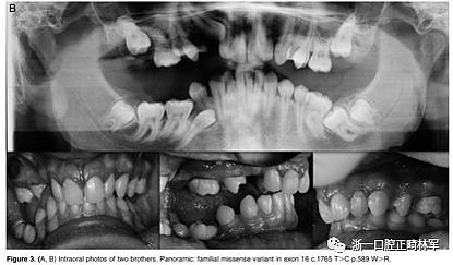 正畸文獻(xiàn)閱讀--原發(fā)性萌出失敗：混合牙列的臨床和遺傳學(xué)研究