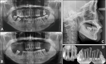 文獻優(yōu)秀正畸病例賞析--多顆牙齒缺失的牙周炎患者的跨學(xué)科綜合治療