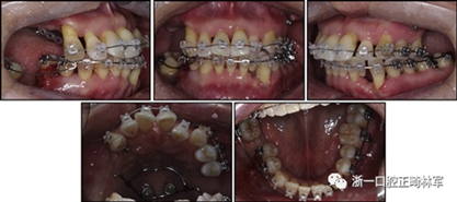 文獻優(yōu)秀正畸病例賞析--多顆牙齒缺失的牙周炎患者的跨學(xué)科綜合治療