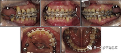 文獻優(yōu)秀正畸病例賞析--多顆牙齒缺失的牙周炎患者的跨學(xué)科綜合治療