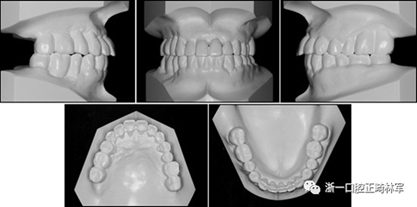 文獻優(yōu)秀正畸病例賞析--多顆牙齒缺失的牙周炎患者的跨學(xué)科綜合治療