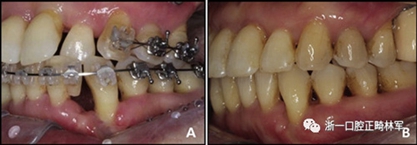 文獻優(yōu)秀正畸病例賞析--多顆牙齒缺失的牙周炎患者的跨學(xué)科綜合治療