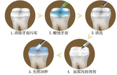 窩溝封閉丨孩子牙齒的“鎧甲勇士”