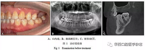 利用壓膜式活動(dòng)矯治器壓入下頜第一、第二磨牙1例