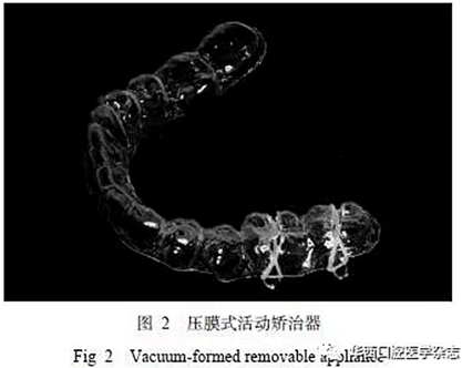 利用壓膜式活動(dòng)矯治器壓入下頜第一、第二磨牙1例