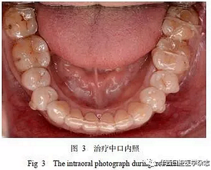 利用壓膜式活動(dòng)矯治器壓入下頜第一、第二磨牙1例