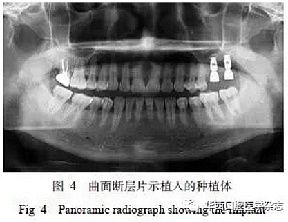 利用壓膜式活動(dòng)矯治器壓入下頜第一、第二磨牙1例