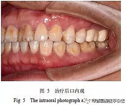 利用壓膜式活動(dòng)矯治器壓入下頜第一、第二磨牙1例