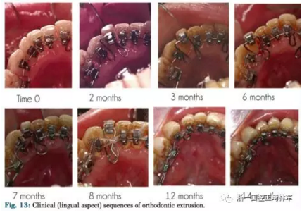 文獻優(yōu)秀正畸病例賞析--正畸牙周聯(lián)合治療方法病例介紹