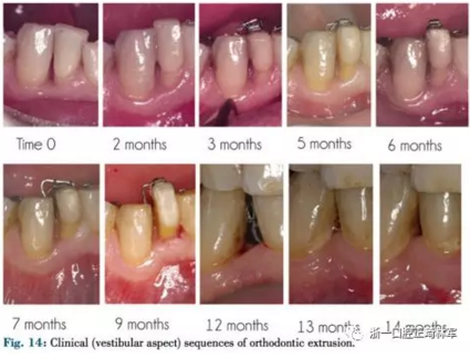 文獻優(yōu)秀正畸病例賞析--正畸牙周聯(lián)合治療方法病例介紹