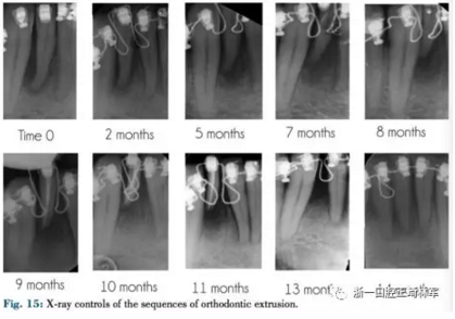文獻優(yōu)秀正畸病例賞析--正畸牙周聯(lián)合治療方法病例介紹