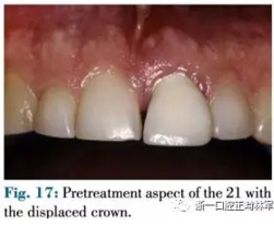 文獻優(yōu)秀正畸病例賞析--正畸牙周聯(lián)合治療方法病例介紹