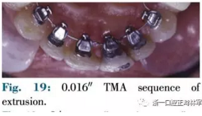 文獻優(yōu)秀正畸病例賞析--正畸牙周聯(lián)合治療方法病例介紹