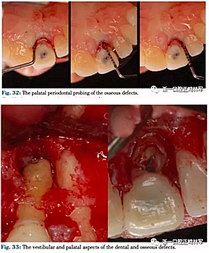 文獻優(yōu)秀正畸病例賞析--正畸牙周聯(lián)合治療方法病例介紹