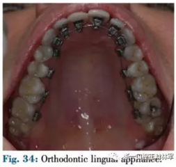 文獻優(yōu)秀正畸病例賞析--正畸牙周聯(lián)合治療方法病例介紹