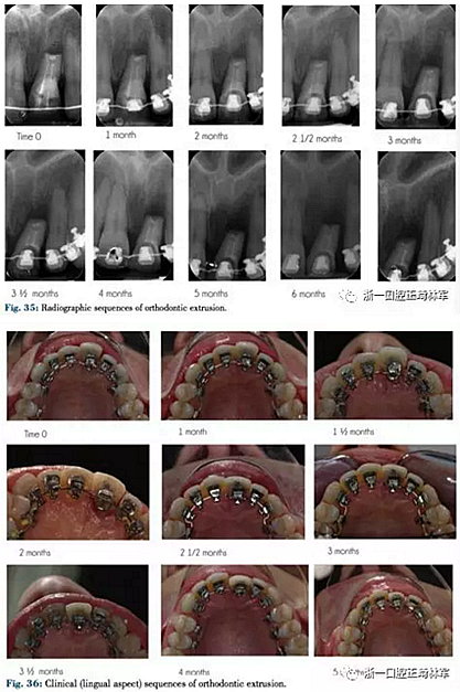 文獻優(yōu)秀正畸病例賞析--正畸牙周聯(lián)合治療方法病例介紹