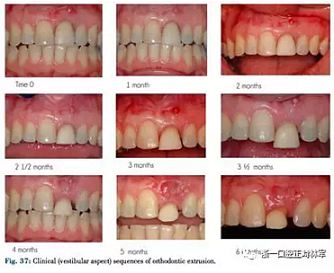 文獻優(yōu)秀正畸病例賞析--正畸牙周聯(lián)合治療方法病例介紹