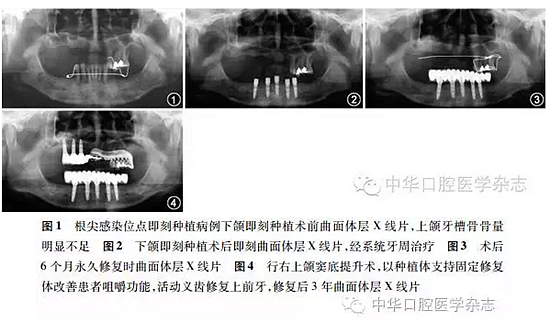 【專家筆談】即刻種植治療方案的評估與實施